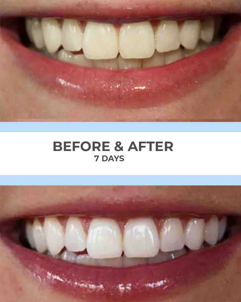 29144 professional teeth whitening