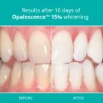 29147 teeth sensitivity