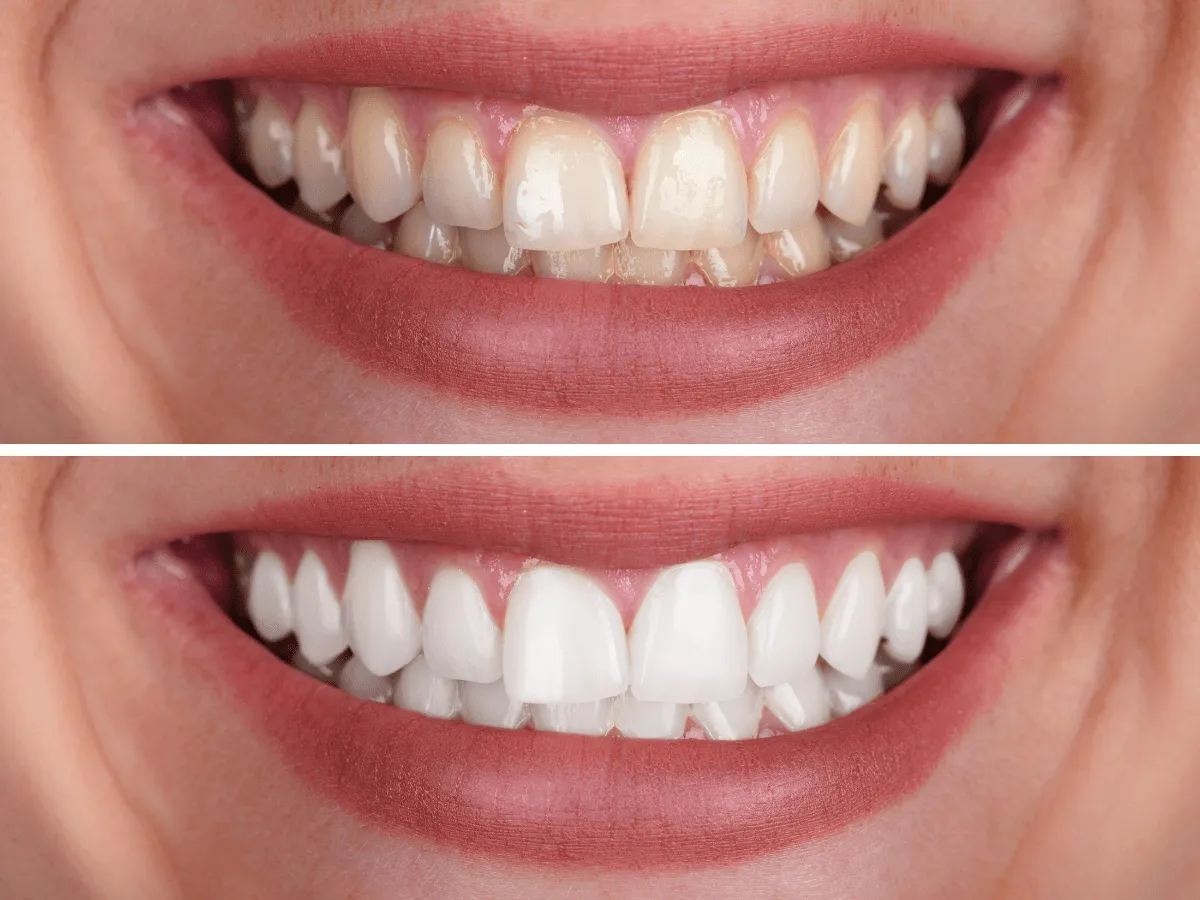 29148 at home teeth whitening kits fairfield