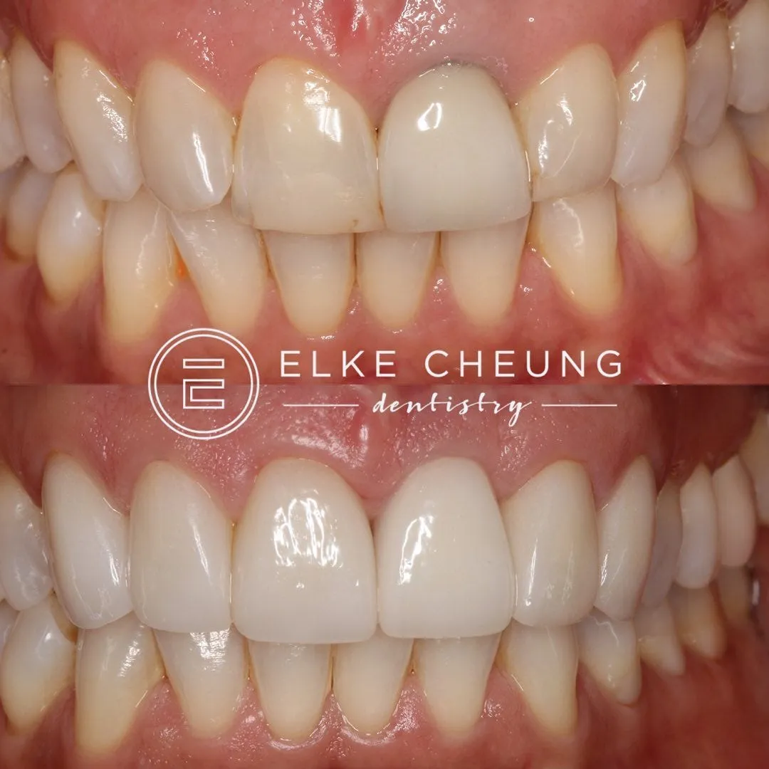 /img/29148-bright-smile-teeth-whitening.webp