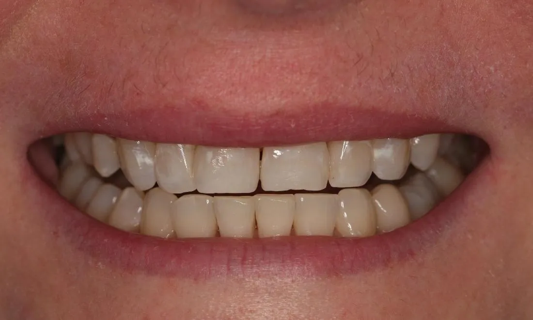 29148 fairfield teeth whitening consultation