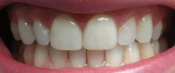 29148 teeth whitening foods to avoid