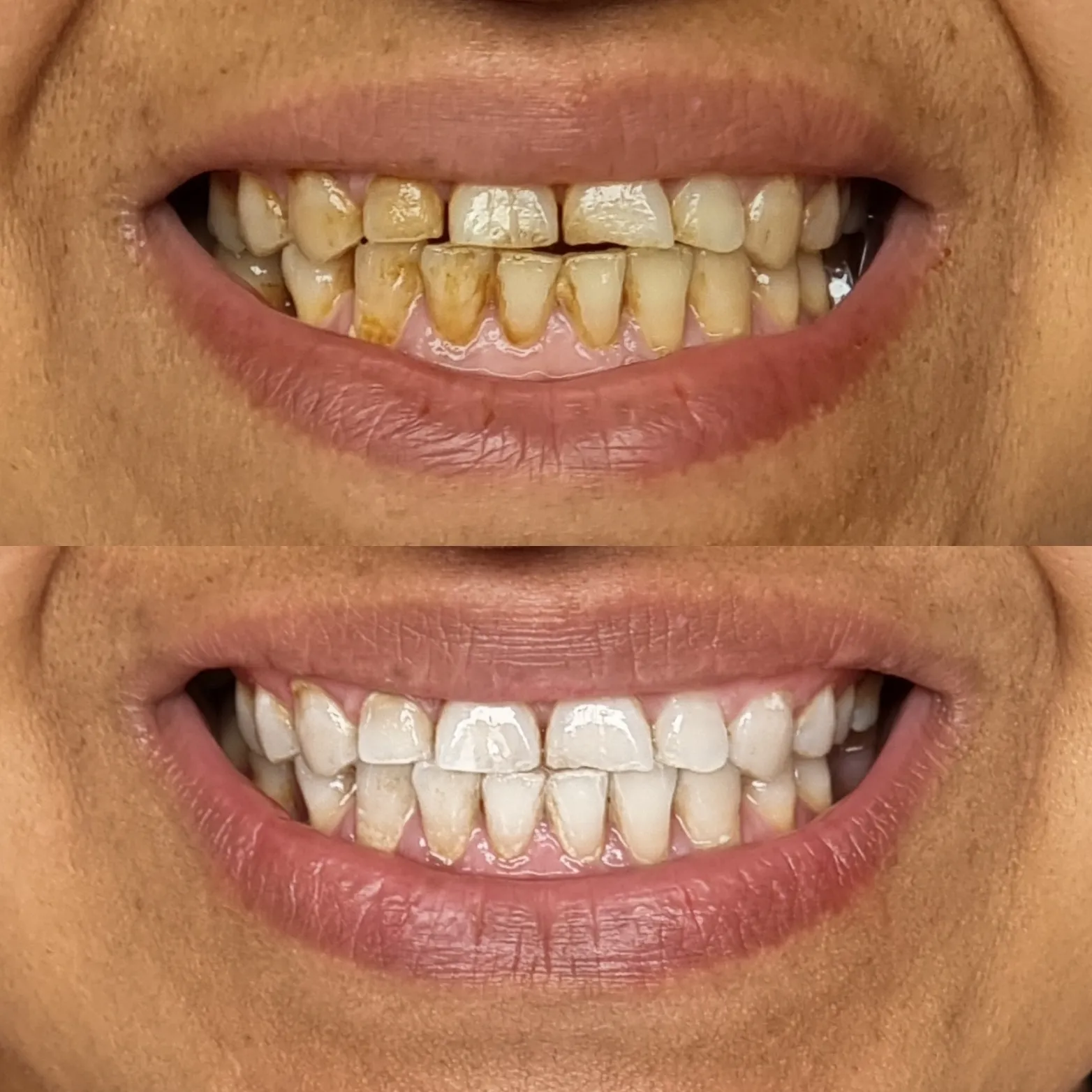 29151 over the counter whitening products