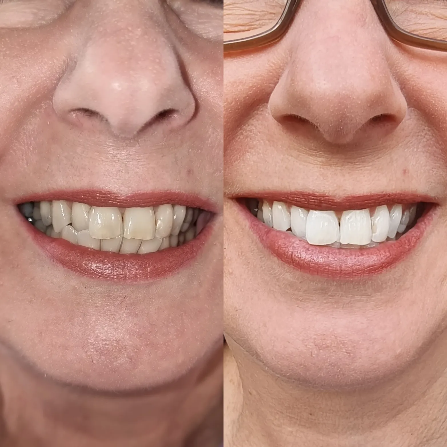 29151 teeth whitening melbourne cost