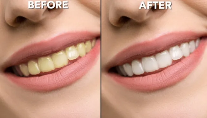 29153 take home whitening kit