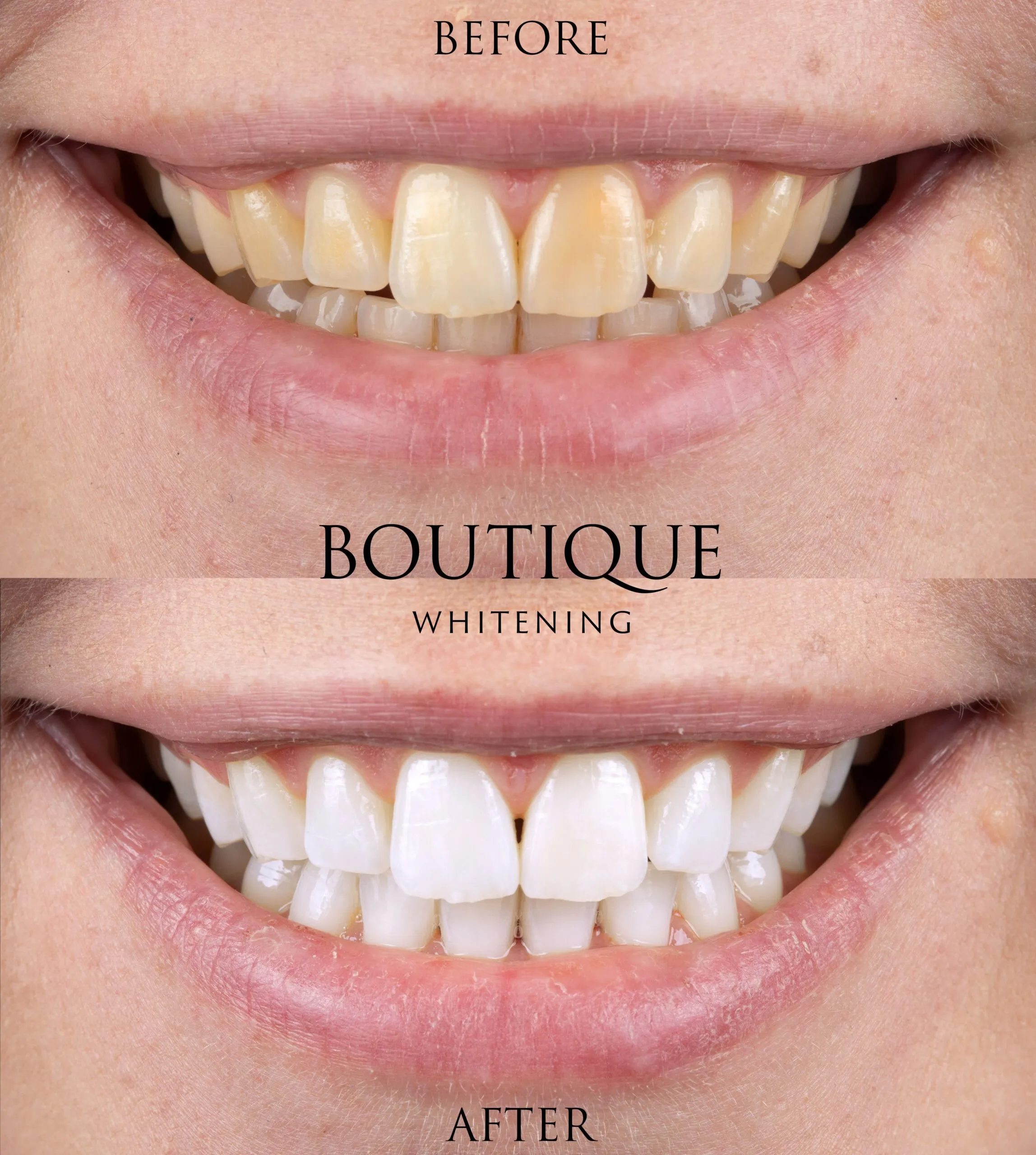 29153 teeth whitening treatment