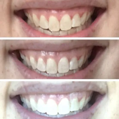29154 at home teeth whitening