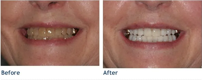 29154 in office teeth whitening