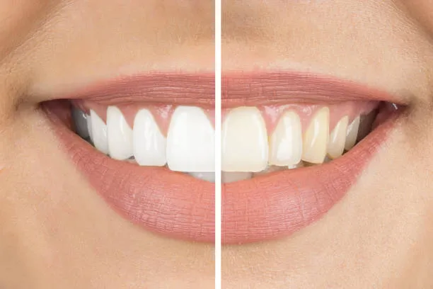 29155 cavity treatment