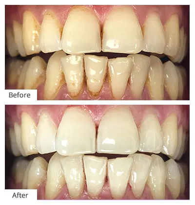 29155 professional teeth cleaning