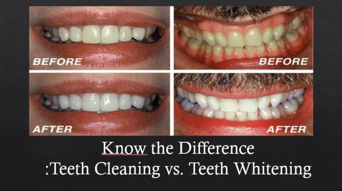 29155 whitening timing