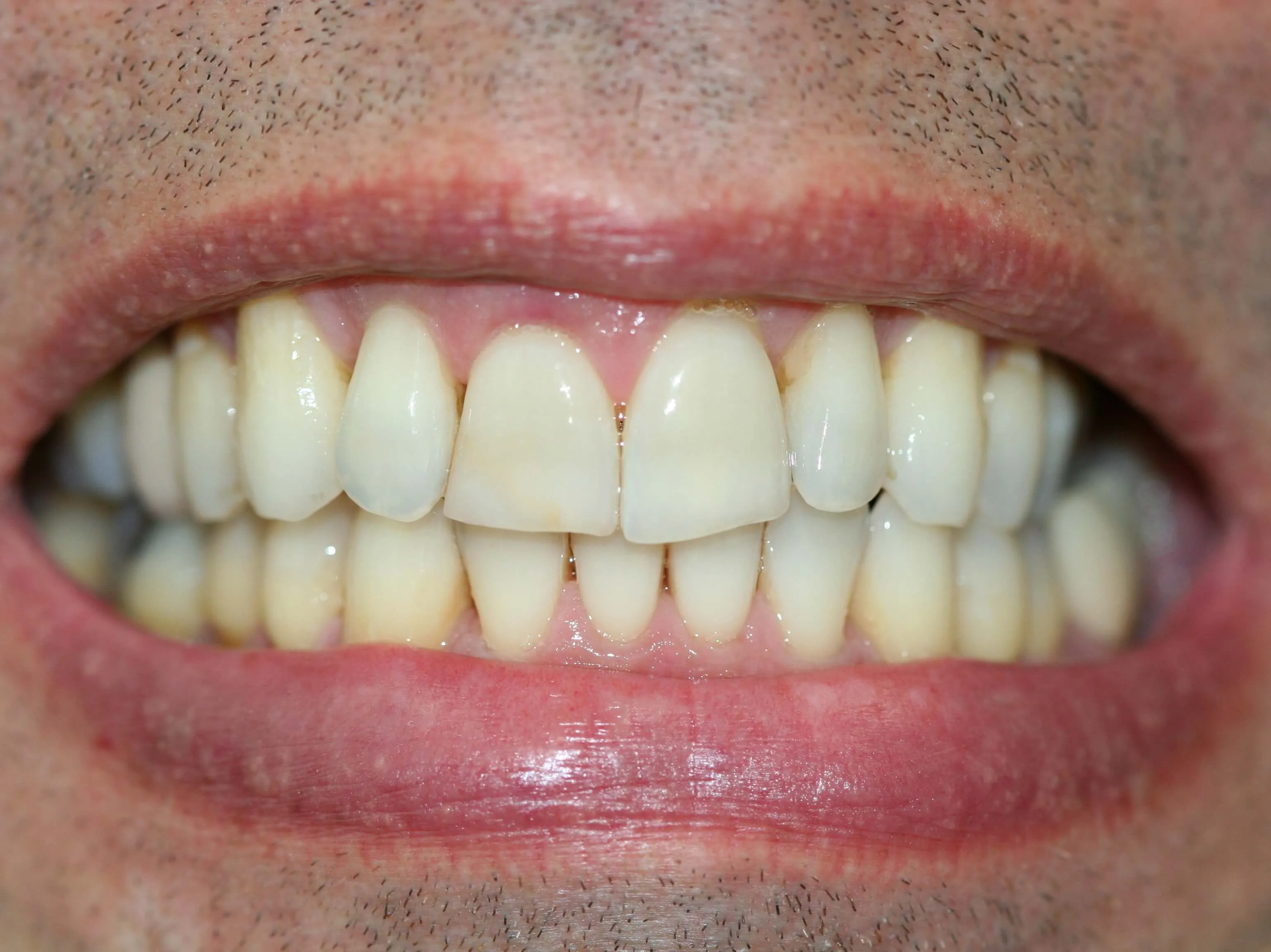 29156 professional teeth whitening