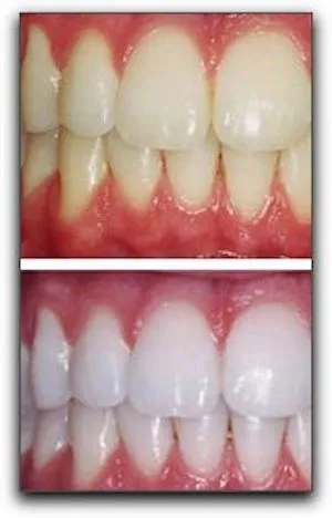 29156 teeth whitening myths