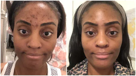 29158 tretinoin skin whitening