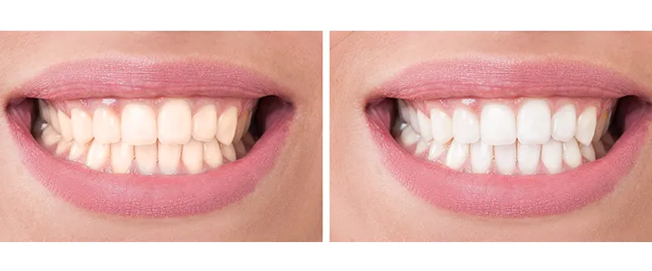 29159 teeth whitening gainesville stain removal