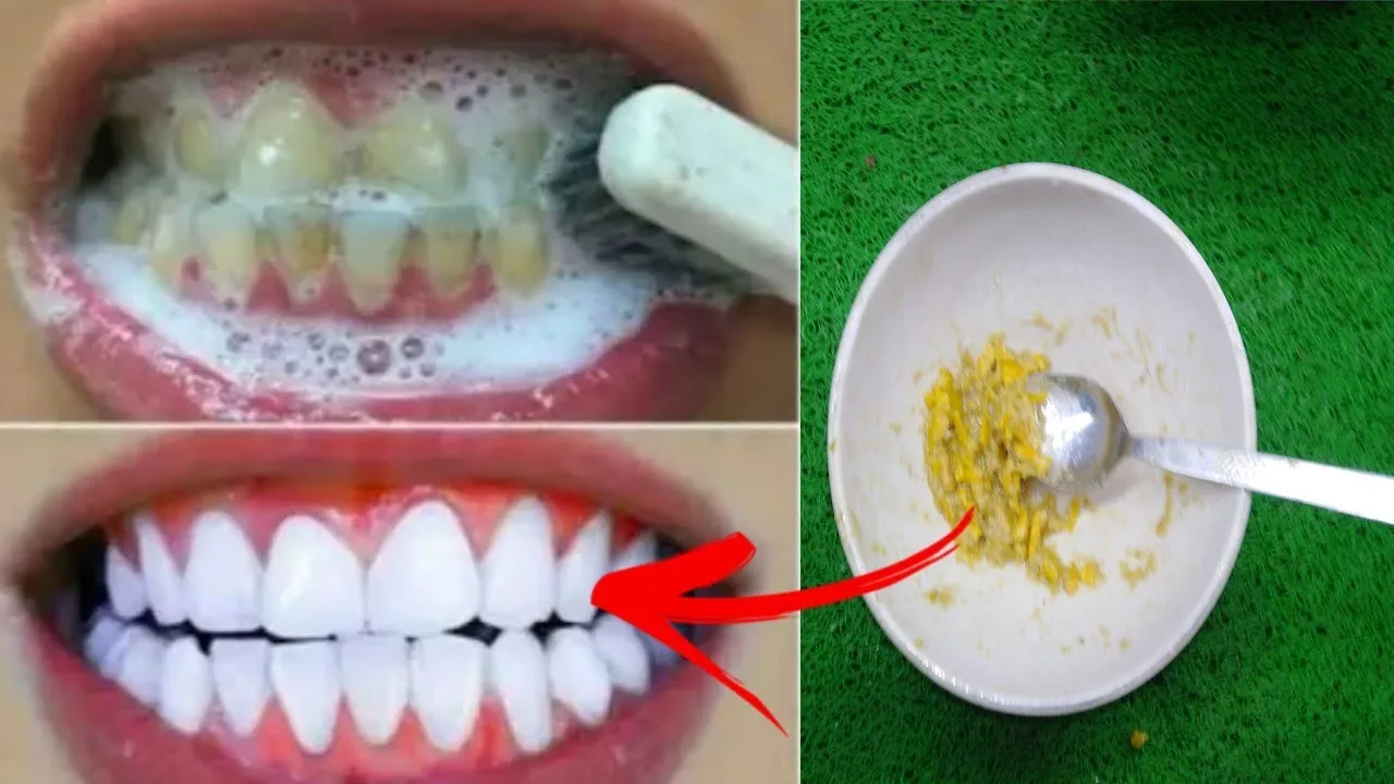 29160 professional teeth whitening
