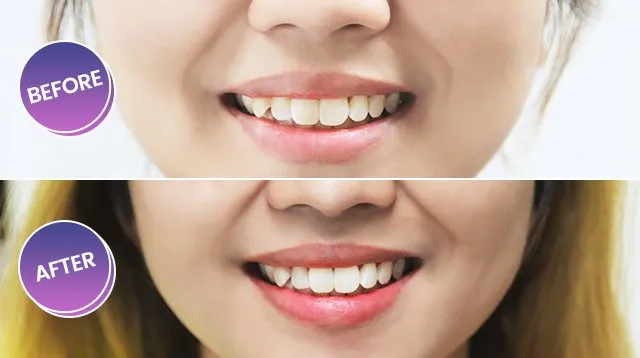29167 at home teeth whitening kits