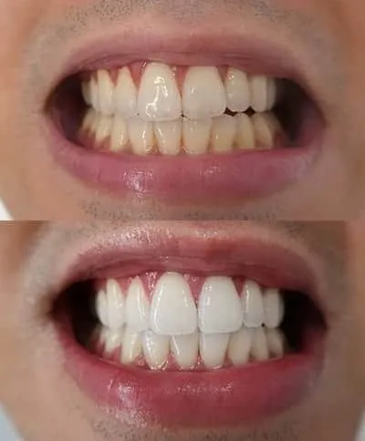 /img/29167-maintaining-white-teeth.webp