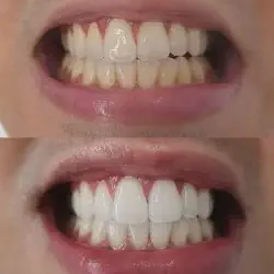 /img/29167-maintaining-white-teeth.webp