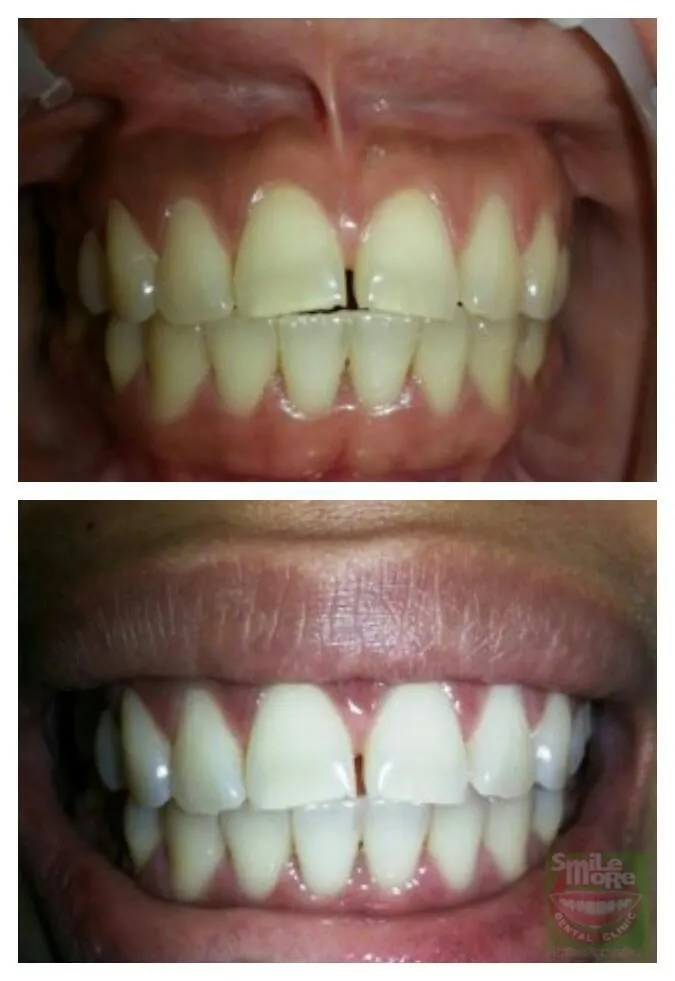 29167 whitening toothpaste philippines