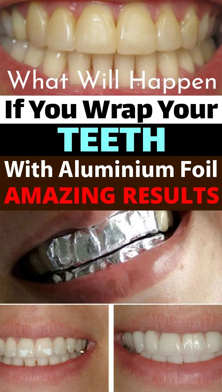 29171 before and after teeth whitening