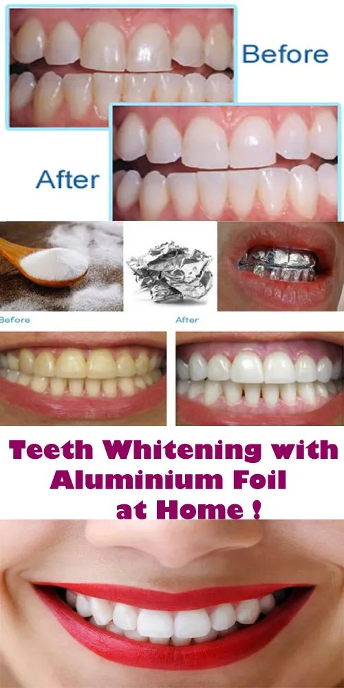 29171 teeth whitening application