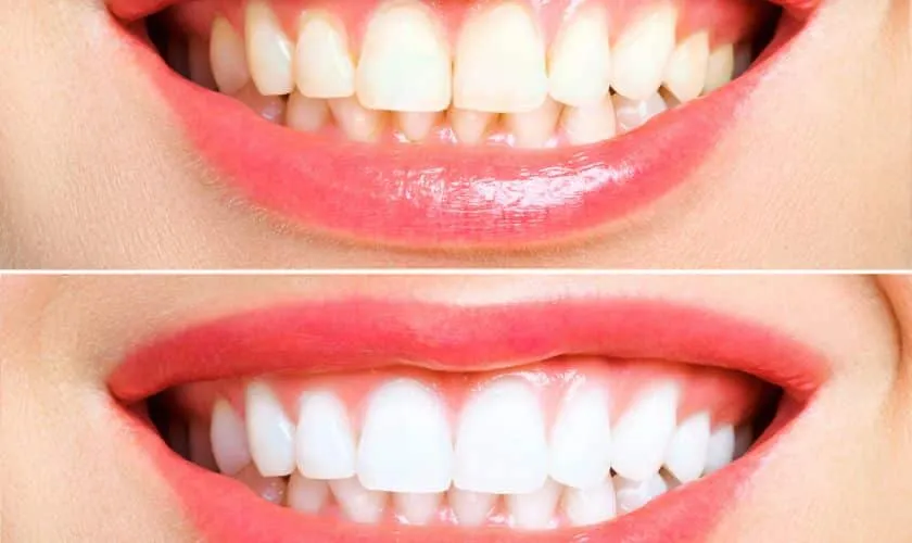 29175 whitening toothpastes