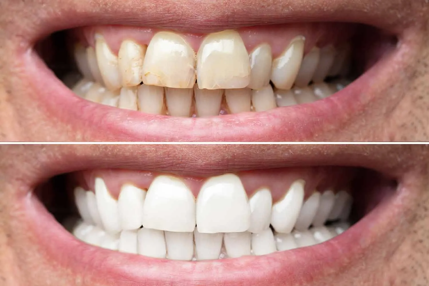 29182 teeth whitening enamel