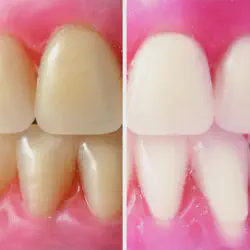 /img/29182-teeth-whitening-maintenance.webp