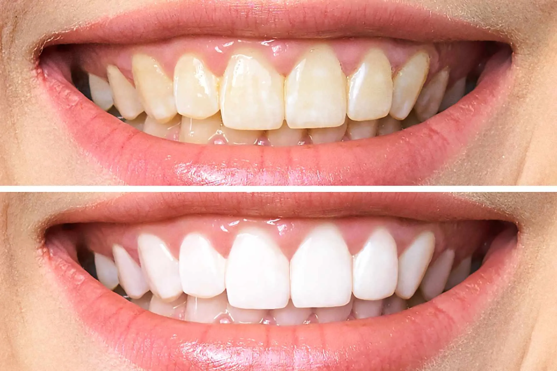 29189 teeth whitening procedures