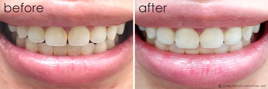 29190 teeth sensitivity