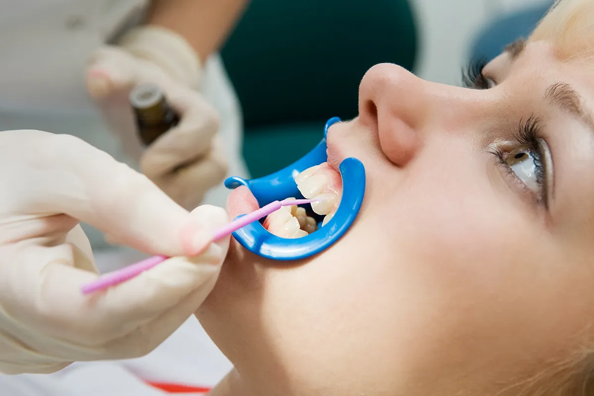 /img/29191-at-home-whitening.webp