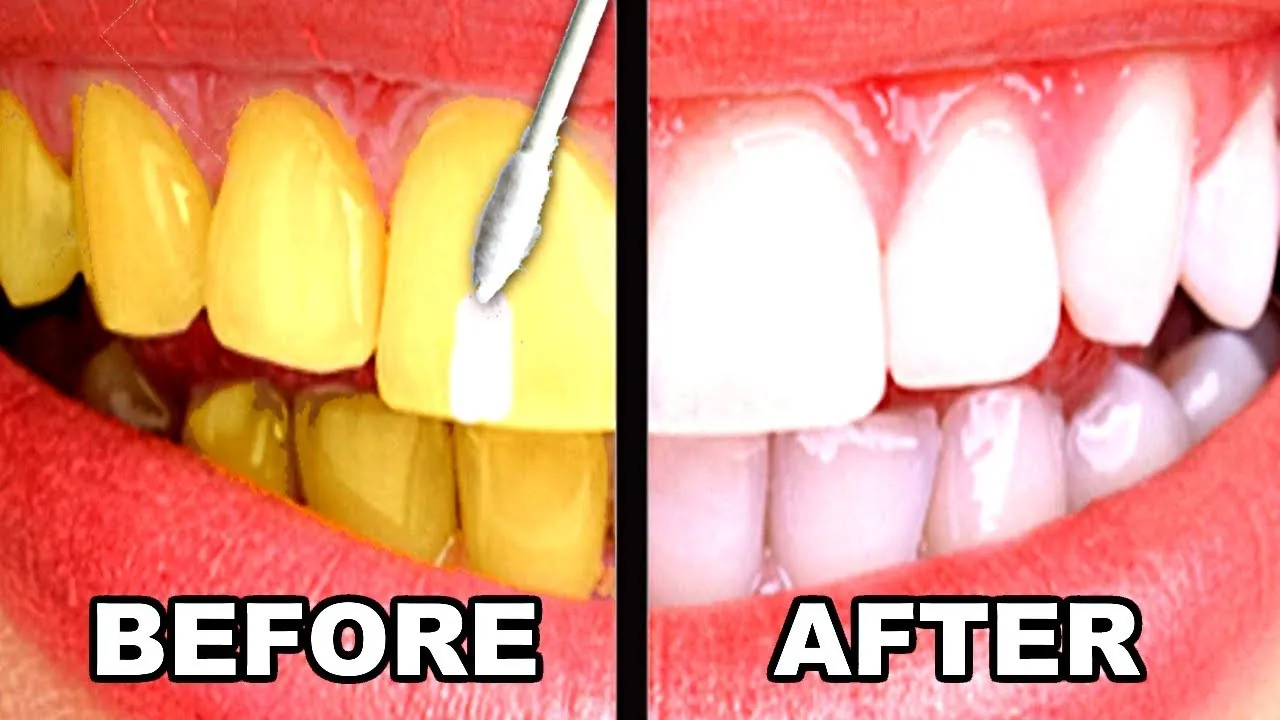 29192 teeth discoloration
