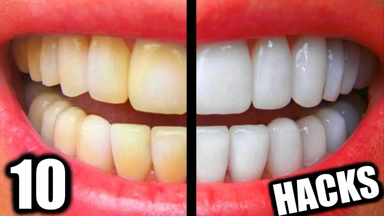 29192 teeth whitening smile