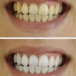 /img/29197-teeth-whitening-henderson-nv-options.webp