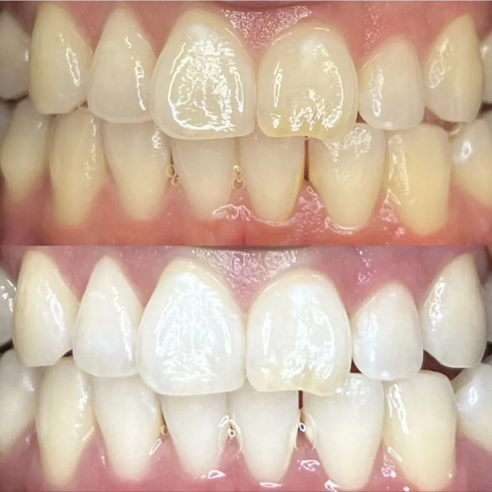 29197 teeth whitening henderson nv professional