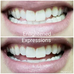 29201 at home teeth whitening kits athens ga