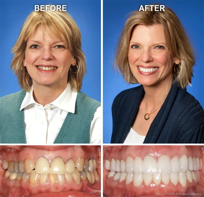 29201 in office teeth whitening athens ga
