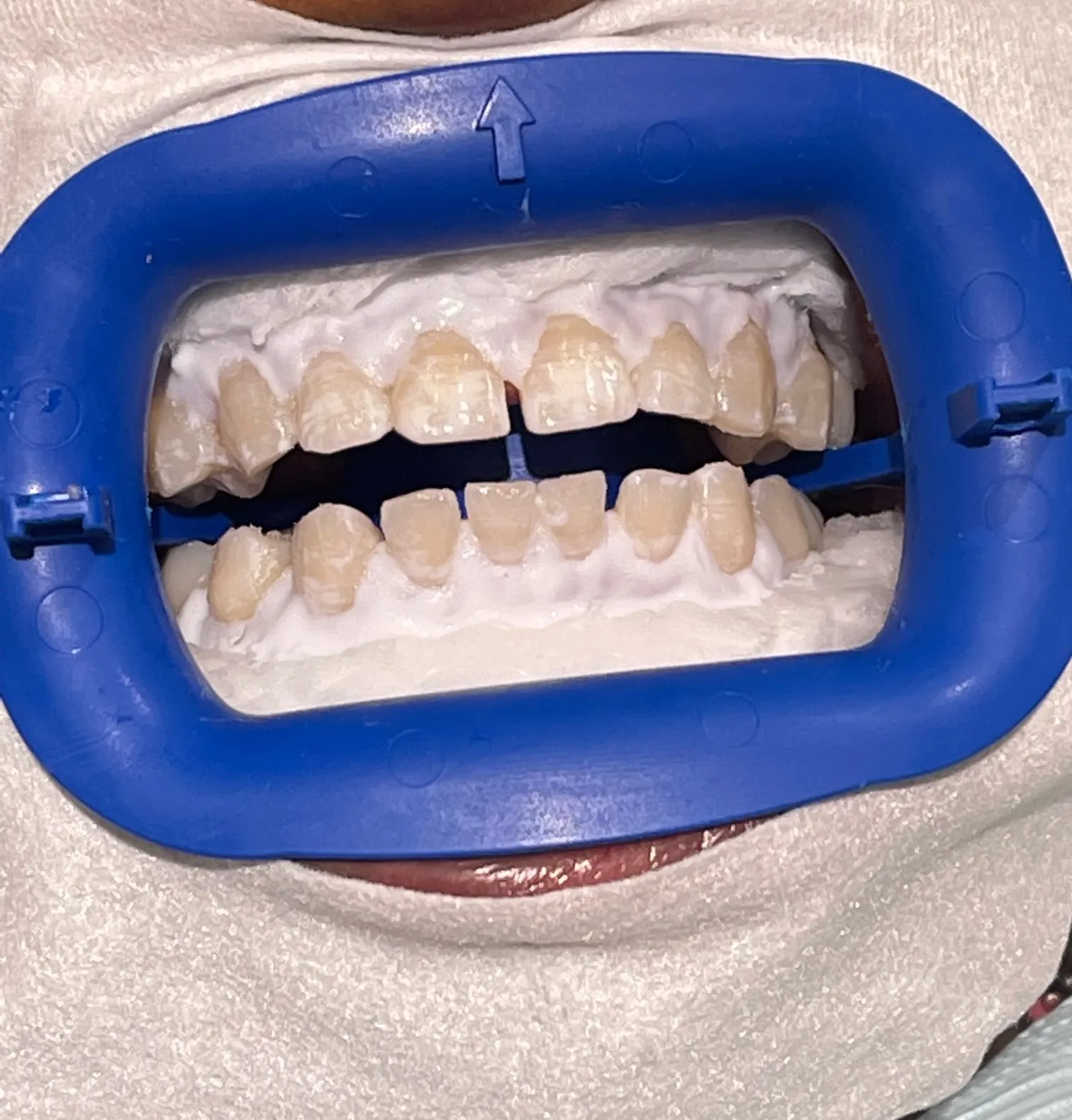 29201 teeth whitening benefits athens ga