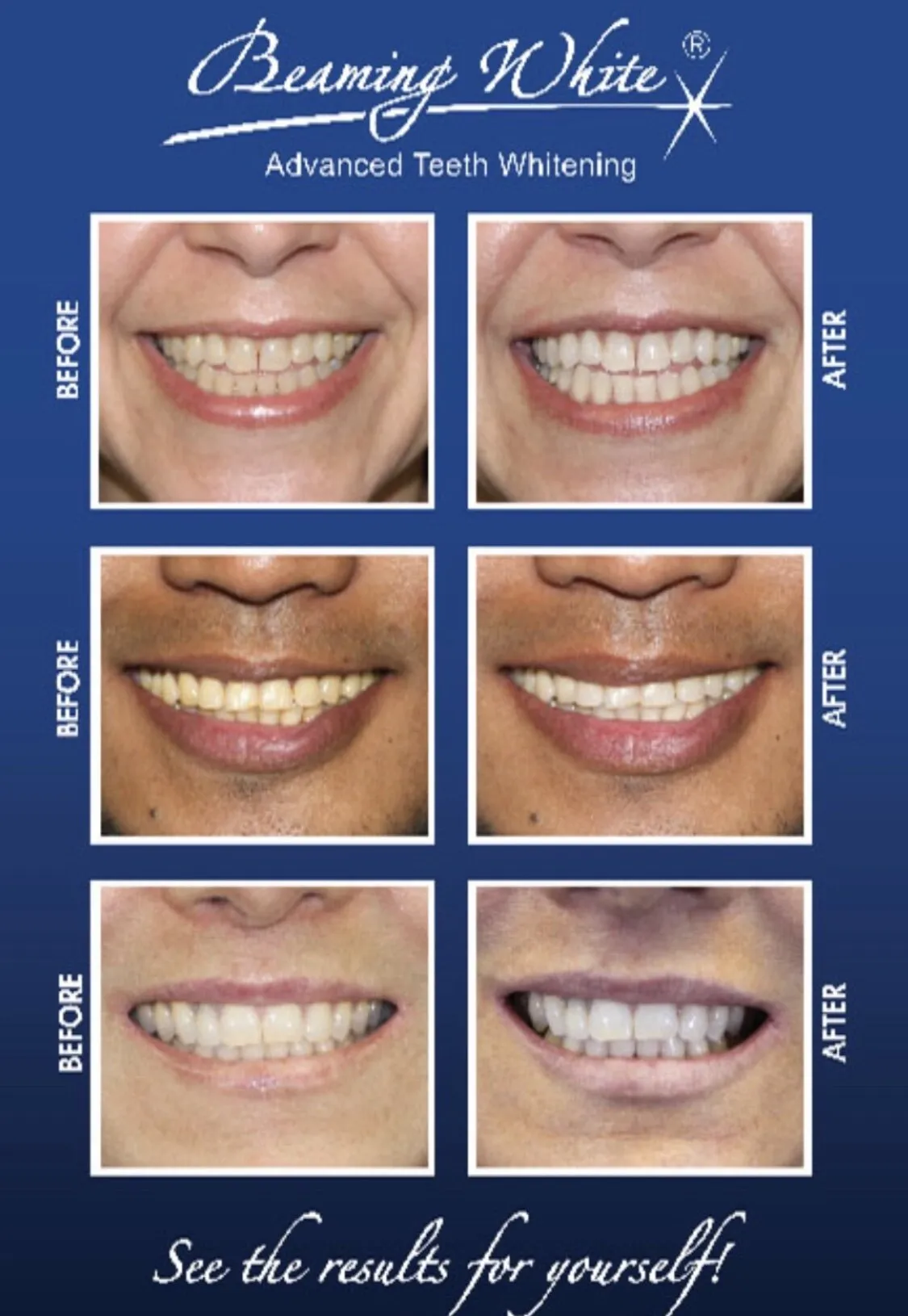 /img/29201-teeth-whitening-risks-athens-ga.webp