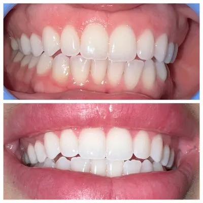 29204 at home whitening kits