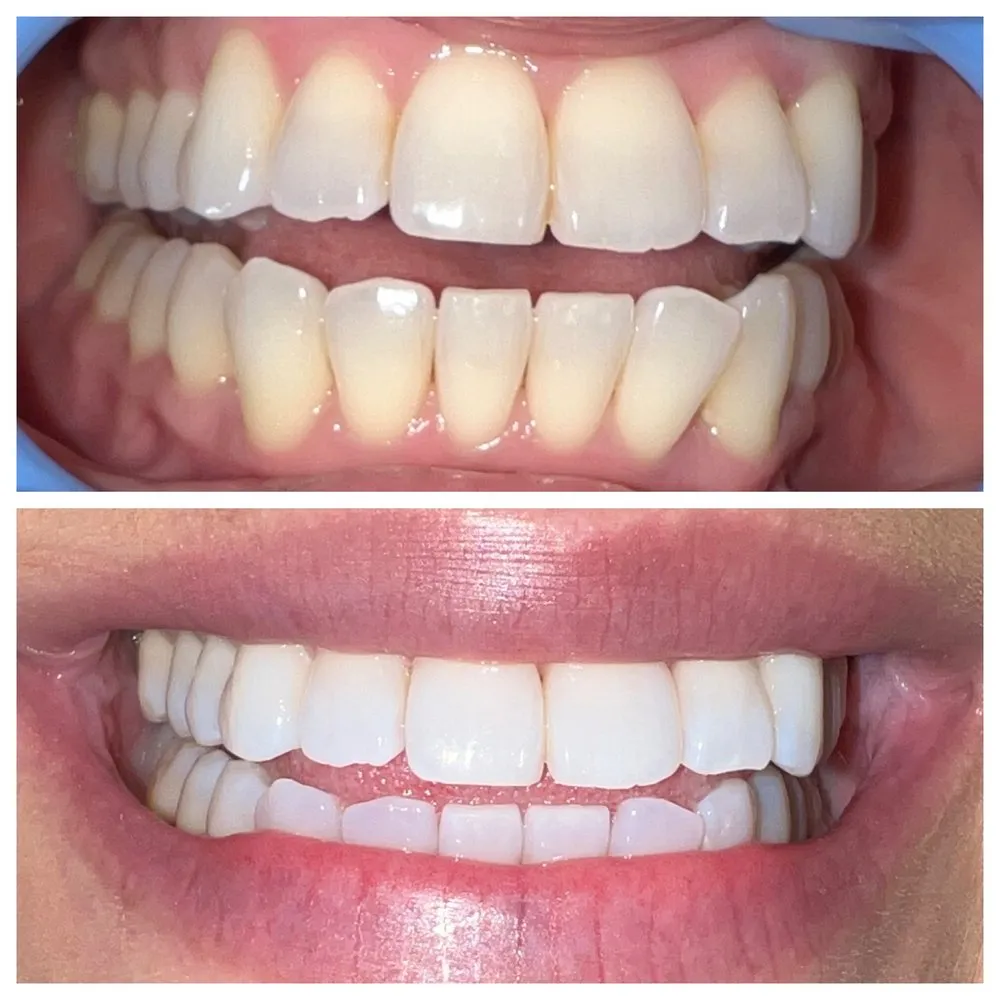 29204 el cajon teeth whitening options