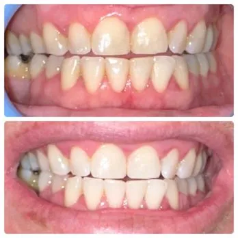 29204 in office teeth whitening