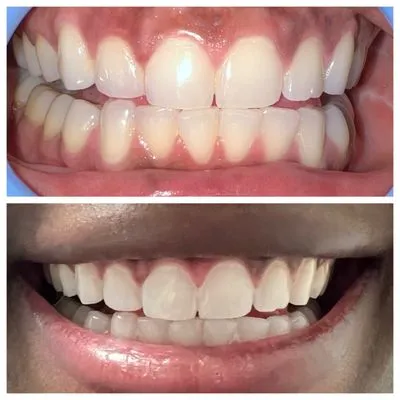 29204 teeth whitening confidence