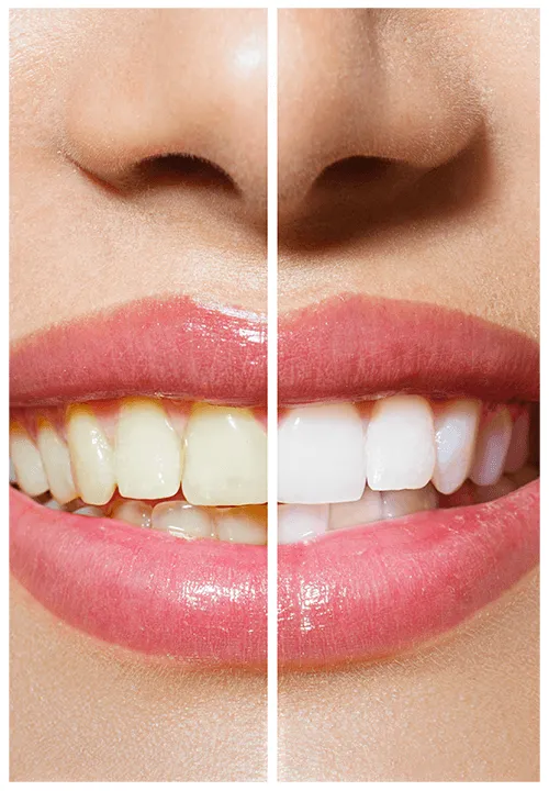 29204 teeth whitening el cajon before after