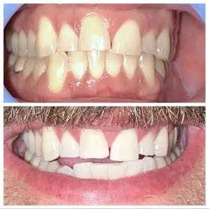 29204 teeth whitening professional