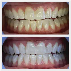 /img/29205-utah-teeth-whitening-maintain.webp