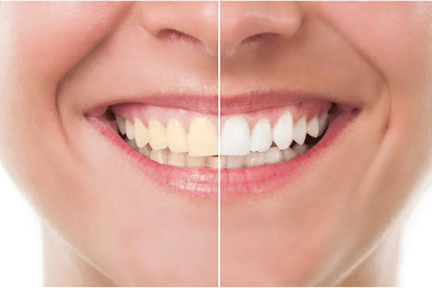 29207 custom whitening trays