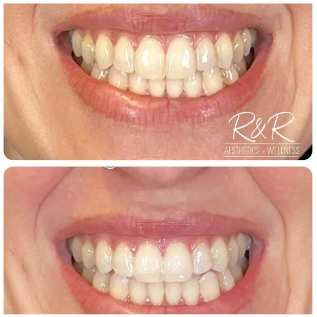 29207 in office whitening
