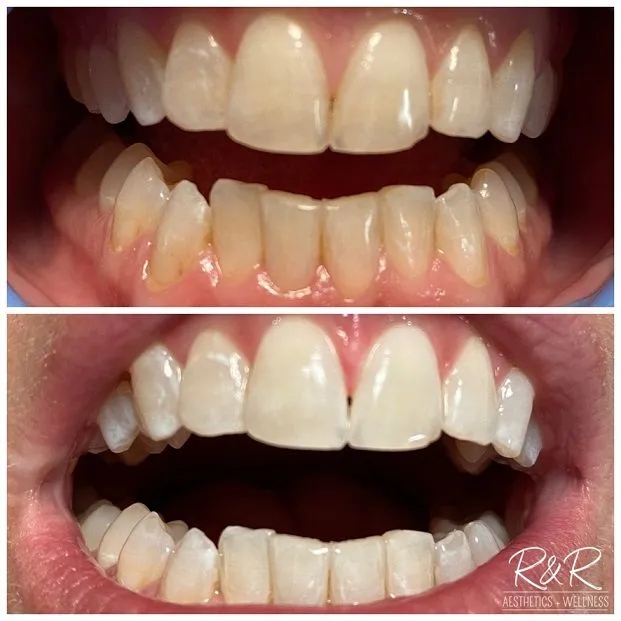 29207 whitening strips